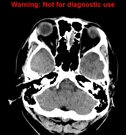 File:Anaplastic ganglioglioma (Radiopaedia 44921-48815 Axial non-contrast 5).jpg
