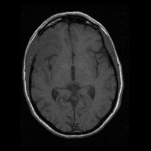 File:Anaplastic meningioma with recurrence (Radiopaedia 34452-35783 Axial T1 10).png