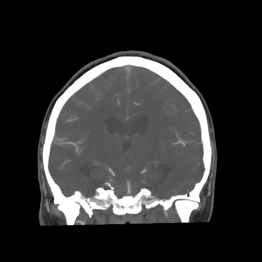 Aneursym related subarachnoid hemorrhage with hydrocephalus (Radiopaedia 45105-49084 B 43).jpg