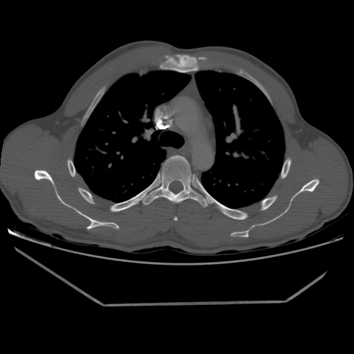 Aneurysmal bone cyst - rib (Radiopaedia 82167-96220 Axial bone window 104).jpg