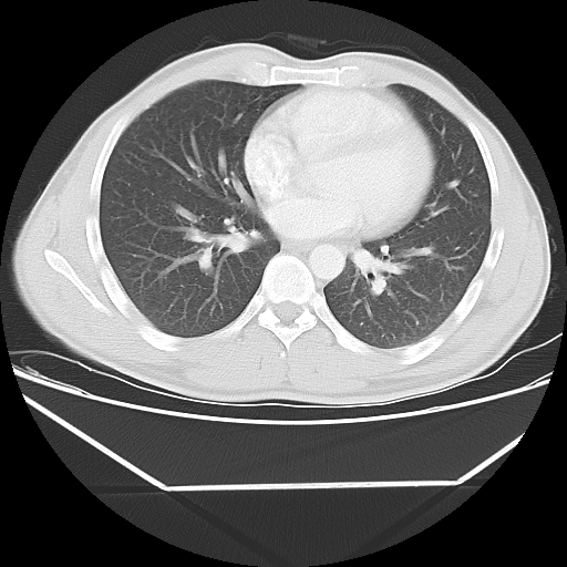 File:Aneurysmal bone cyst - rib (Radiopaedia 82167-96220 Axial lung window 40).jpg