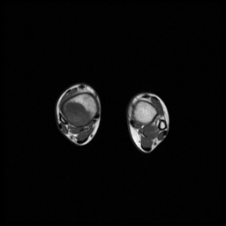 File:Aneurysmal bone cyst - tibia (Radiopaedia 22343-22367 Axial T1 14).jpg