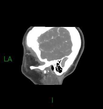 Aneurysmal subarachnoid hemorrhage with intra-axial extension (Radiopaedia 84371-99732 B 62).jpg
