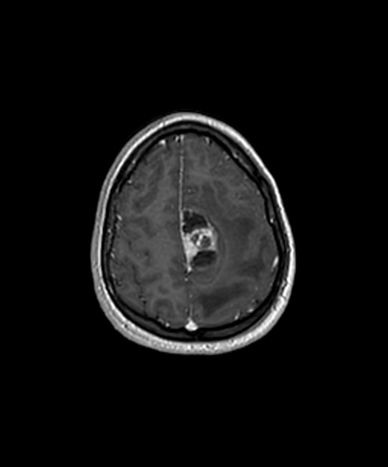 Angiomatous meningioma (Radiopaedia 79459-92577 Axial T1 C+ 3D ISO 47).jpg