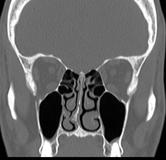 Angular epidermoid cyst (Radiopaedia 46908-51439 Coronal bone window 32).png