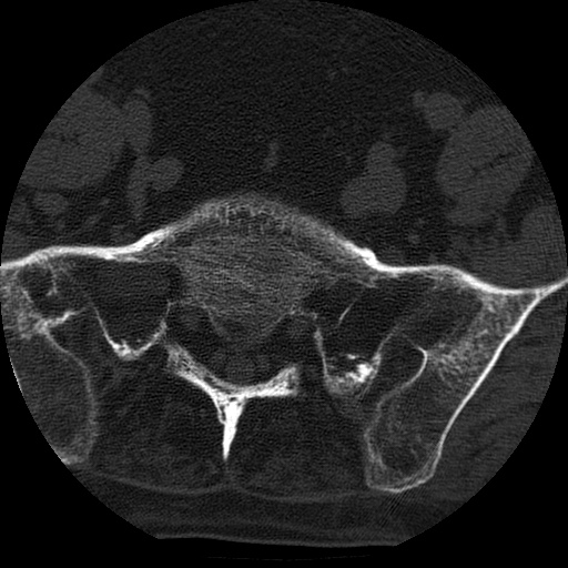 File:Ankylosing spondylitis complicated by fracture-dislocation (Radiopaedia 33583-34674 Axial non-contrast 156).jpg