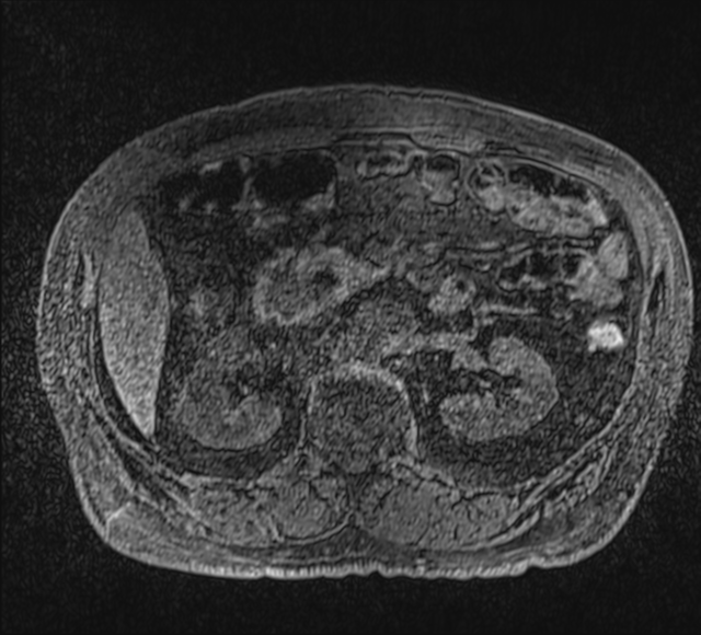 Annular pancreas (Radiopaedia 38292-40320 Axial T1 fat sat 46).png