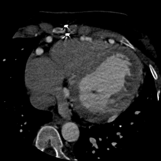 File:Anomalous left coronary artery from the pulmonary artery (ALCAPA) (Radiopaedia 40884-43586 A 58).jpg