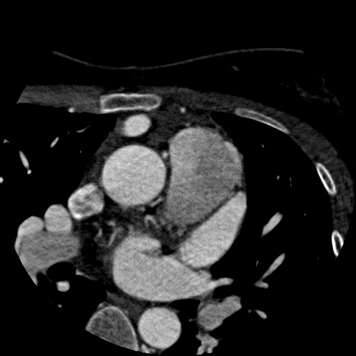 File:Anomalous left coronary artery from the pulmonary artery (ALCAPA) (Radiopaedia 40884-43586 A 9).jpg