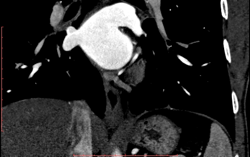 Anomalous left coronary artery from the pulmonary artery (ALCAPA) (Radiopaedia 70148-80181 B 221).jpg