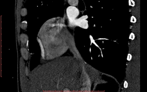 File:Anomalous left coronary artery from the pulmonary artery (ALCAPA) (Radiopaedia 70148-80181 C 29).jpg