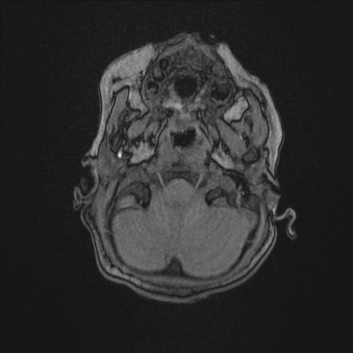 Anoxic brain injury (Radiopaedia 79165-92139 Axial MRA 29).jpg