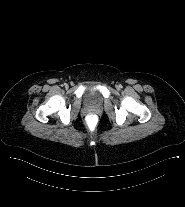 Anterior abdominal wall CSF pseudocyst (CSFoma) (Radiopaedia 79453-92571 A 91).jpg