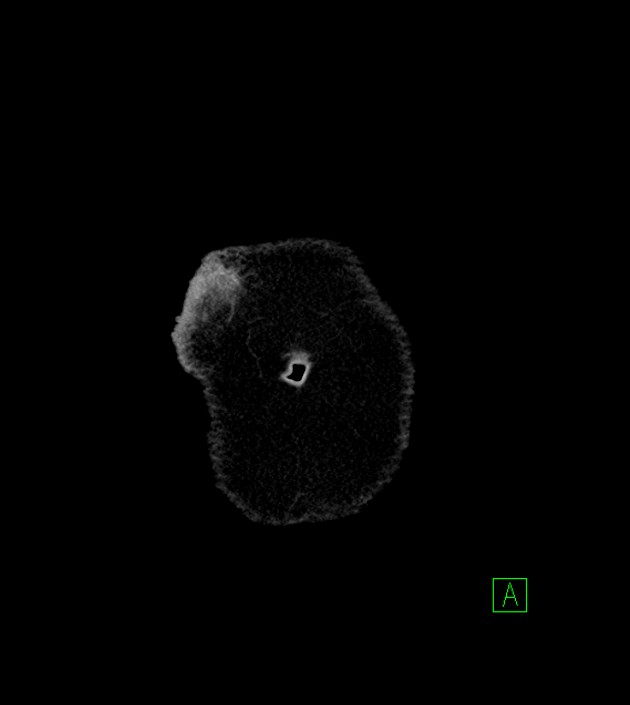 Anterior abdominal wall CSF pseudocyst (CSFoma) (Radiopaedia 79453-92571 B 3).jpg