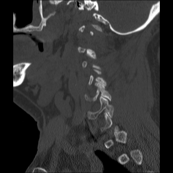 Anterior cervical postdiscectomy arthrodesis (Radiopaedia 32678-33646 Sagittal bone window 61).jpg