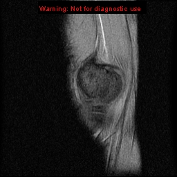 File:Anterior cruciate ligament injury - partial thickness tear (Radiopaedia 12176-12515 A 2).jpg