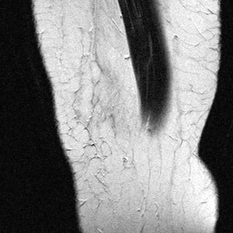 File:Anterior cruciate ligament mucoid degeneration (Radiopaedia 60853-68633 Sagittal T2 3).jpg
