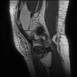 Anterior cruciate ligament rupture with Segond fracture (Radiopaedia 69043-78806 Sagittal PD 161).jpg