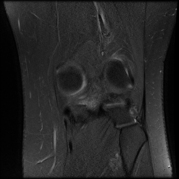 File:Anterior cruciate ligament tear, Wrisberg rip and bucket-handle tear of medial meniscus (Radiopaedia 75872-87266 Coronal PD fat sat 21).jpg