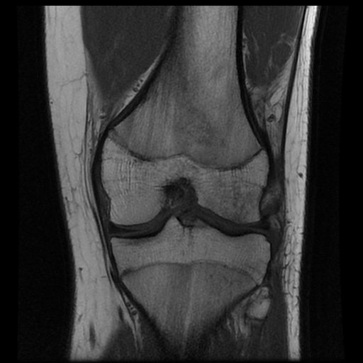 File:Anterior cruciate ligament tear (Radiopaedia 61500-69462 Coronal T1 12).jpg