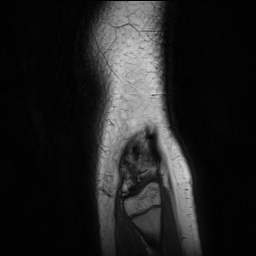 Anterior cruciate ligament tear - pediatric (Radiopaedia 62152-70260 Sagittal PD 163).jpg