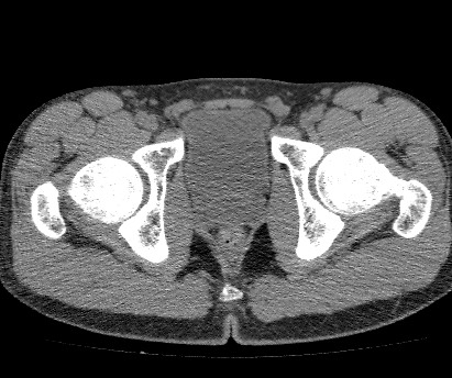 Anterior inferior iliac spine avulsion fracture (Radiopaedia 81312-94999 Axial non-contrast 58).jpg