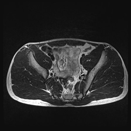 File:Anterior inferior iliac spine avulsion fracture (Radiopaedia 81312-95000 Axial T2 29).jpg