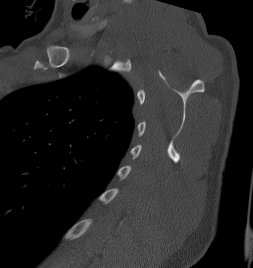 Anterior shoulder dislocation with Hill-Sachs and bony Bankart lesions (Radiopaedia 40424-42974 Sagittal bone window 42).png