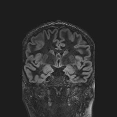 Anterior temporal encephalocele (Radiopaedia 82624-96808 Coronal FLAIR 23).jpg