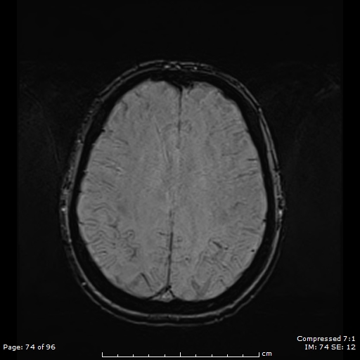 Anterior temporal lobe perivascular space (Radiopaedia 88283-104914 Axial SWI 43).jpg