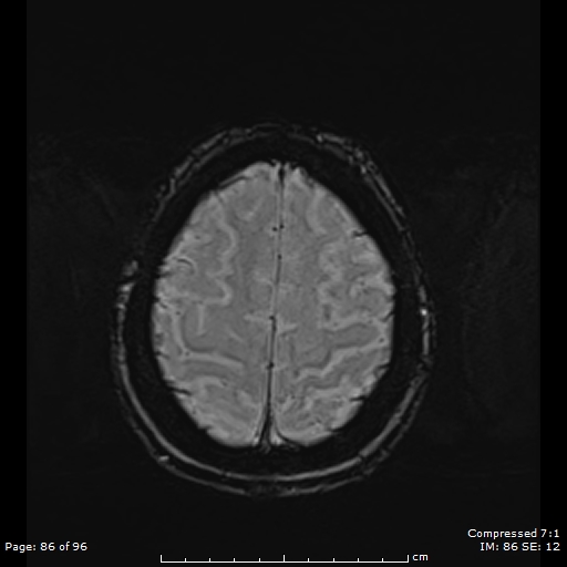 Anterior temporal lobe perivascular space (Radiopaedia 88283-104914 Axial SWI 55).jpg