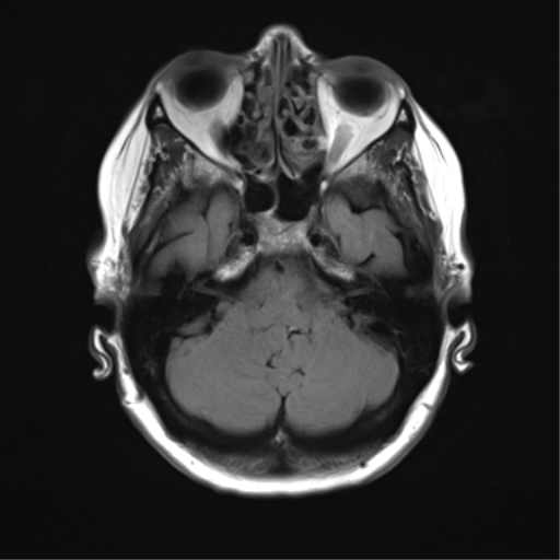 File:Anterior temporal pole cysts (Radiopaedia 46629-51102 Axial FLAIR 6).png