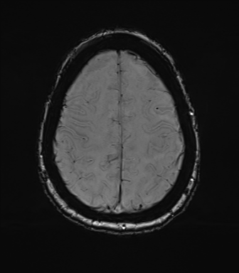 Anterior temporal pole cysts (Radiopaedia 46629-51102 Axial SWI 69).png