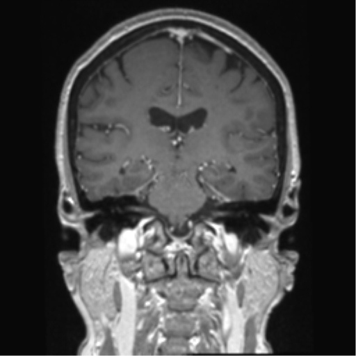 Anterior temporal pole cysts (Radiopaedia 46629-51102 Coronal T1 C+ 77).png