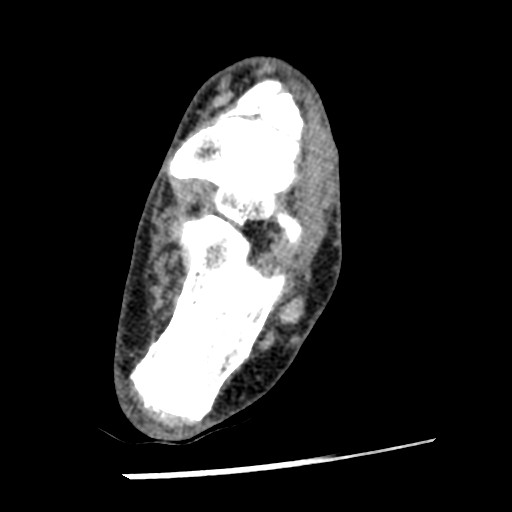 Anterior tibial artery false aneurysm (Radiopaedia 88984-105809 A 172).jpg