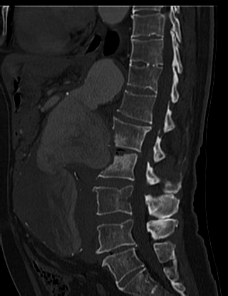 File:Anterior vertebral scalloping (abdominal aortic aneurysm) (Radiopaedia 66744-76067 Sagittal bone window 41).jpg