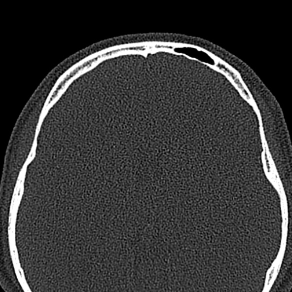 Antrochoanal polyp (Radiopaedia 30002-30554 Axial bone window 62).jpg