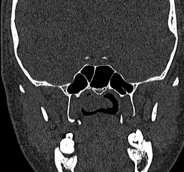 Antrochoanal polyp (Radiopaedia 30002-30554 Coronal bone window 64).jpg