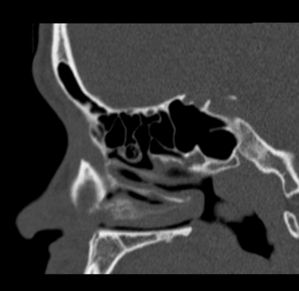 Antrochoanal polyp (Radiopaedia 33984-35202 Sagittal bone window 50).jpg