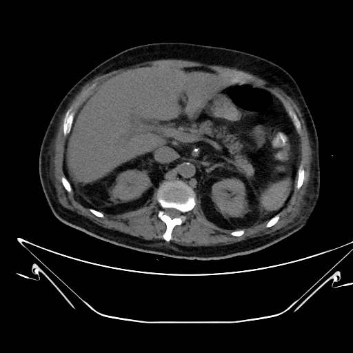 Aortic arch aneurysm (Radiopaedia 84109-99365 Axial non-contrast 297).jpg