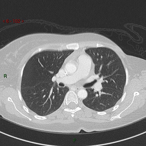 Aortic arch origin of left vertebral artery (Radiopaedia 51520-57286 Axial lung window 102).jpg