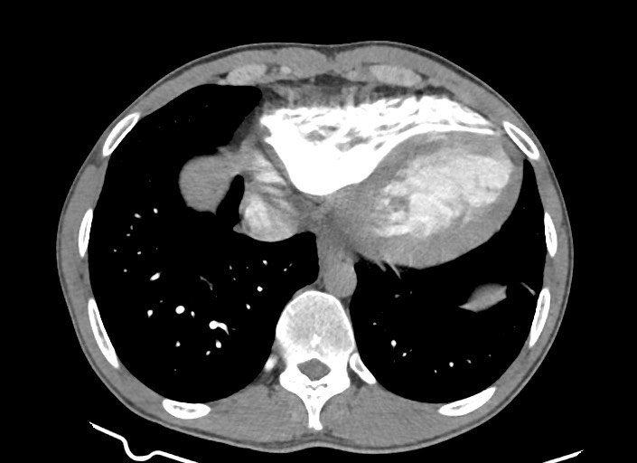 File:Aortic coarctation with aneurysm (Radiopaedia 74818-85828 A 60).jpg