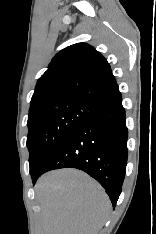 Aortic coarctation with aneurysm (Radiopaedia 74818-85828 B 33).jpg