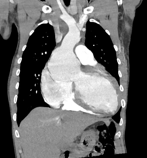 Aortic coarctation with aneurysm (Radiopaedia 74818-85828 C 41).jpg
