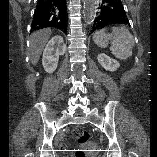 Aortic dissection- Stanford A (Radiopaedia 35729-37268 F 7).jpg