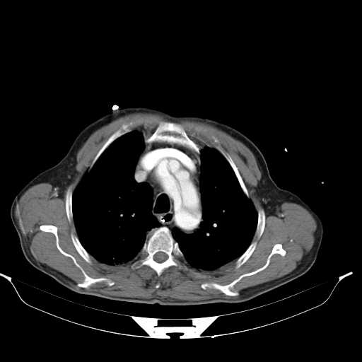 Aortic dissection- Stanford type A (Radiopaedia 22085-22085 A 14).jpg