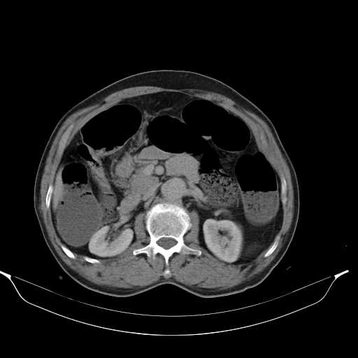 File:Aortic dissection- Stanford type A (Radiopaedia 22085-22085 Axial C+ delayed 20).jpg