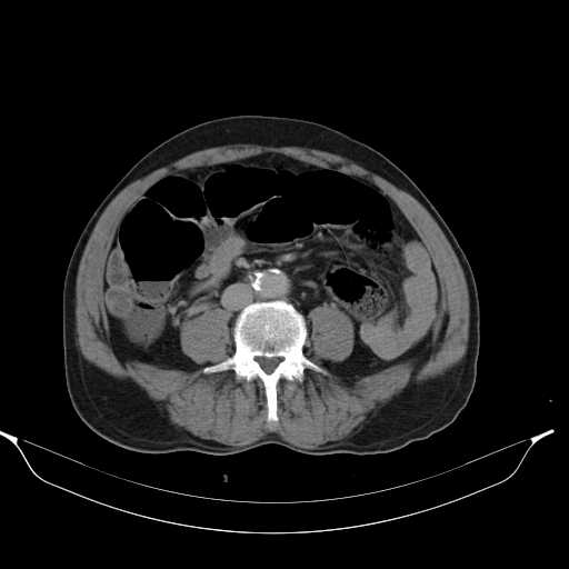File:Aortic dissection- Stanford type A (Radiopaedia 22085-22085 Axial C+ delayed 32).jpg