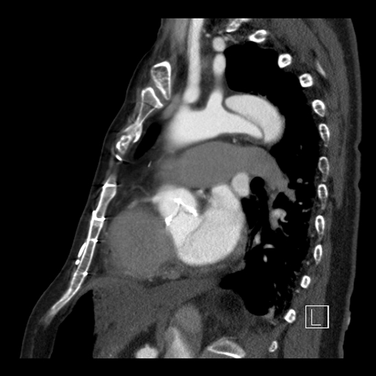 Aortic dissection (CTPA) (Radiopaedia 75506-86750 C 65).jpg