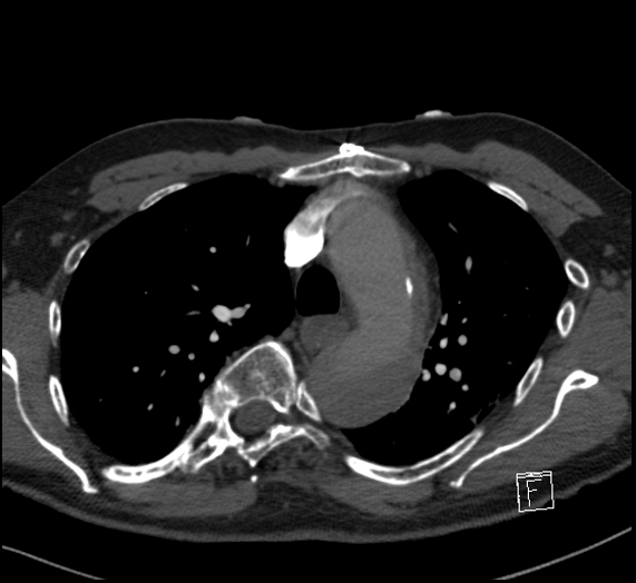 File:Aortic dissection (CTPA) (Radiopaedia 75506-86751 Axial C+ CTPA 44).jpg